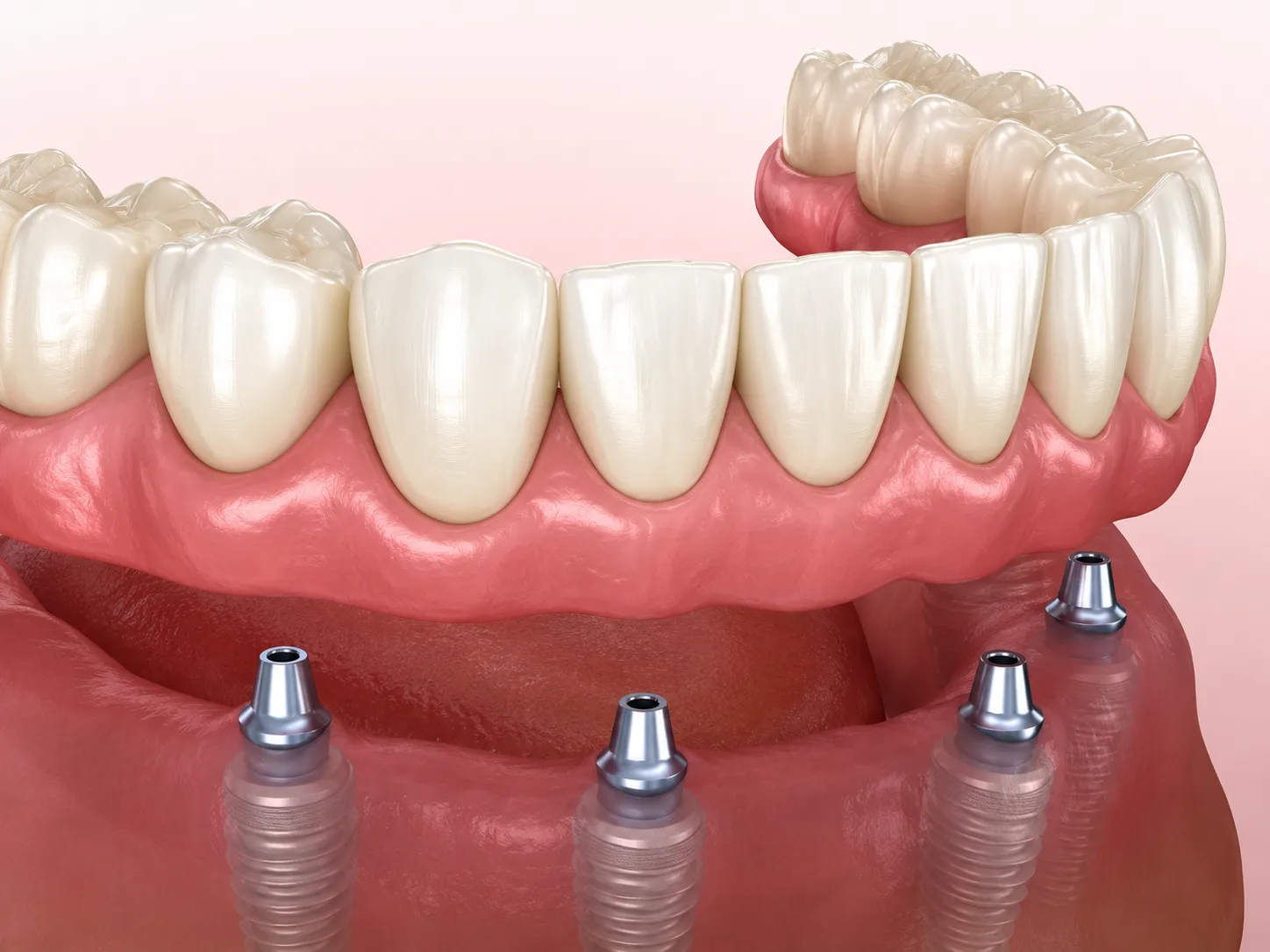 Full Mouth Solutions