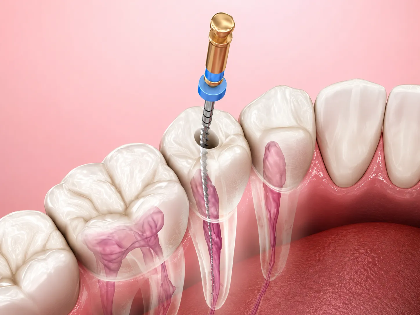 Root Canal